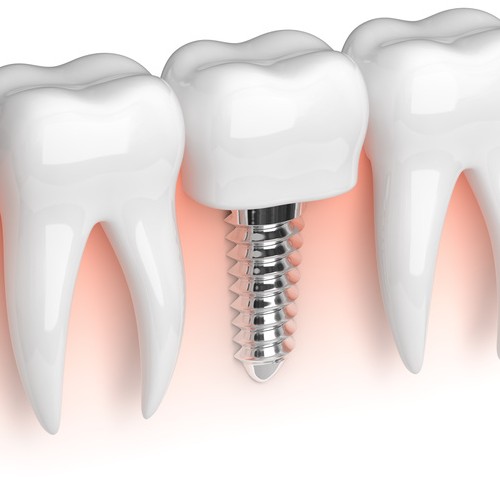 Implantation: So verläuft eine Behandlung mit Implantaten