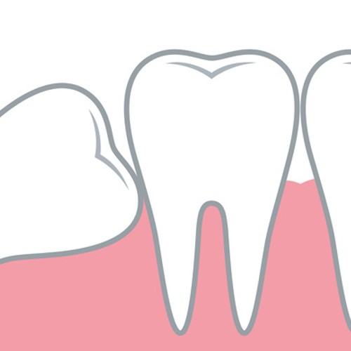 Weisheitszähne entfernen – ja oder nein?